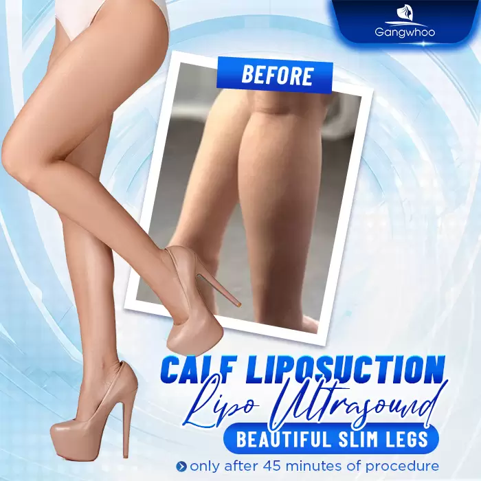 Calf Liposuction – Farewell Your Oversize Legs