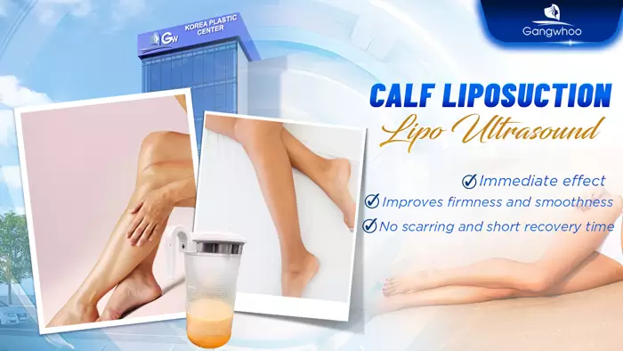 Calf Liposuction – Farewell Your Oversize Legs