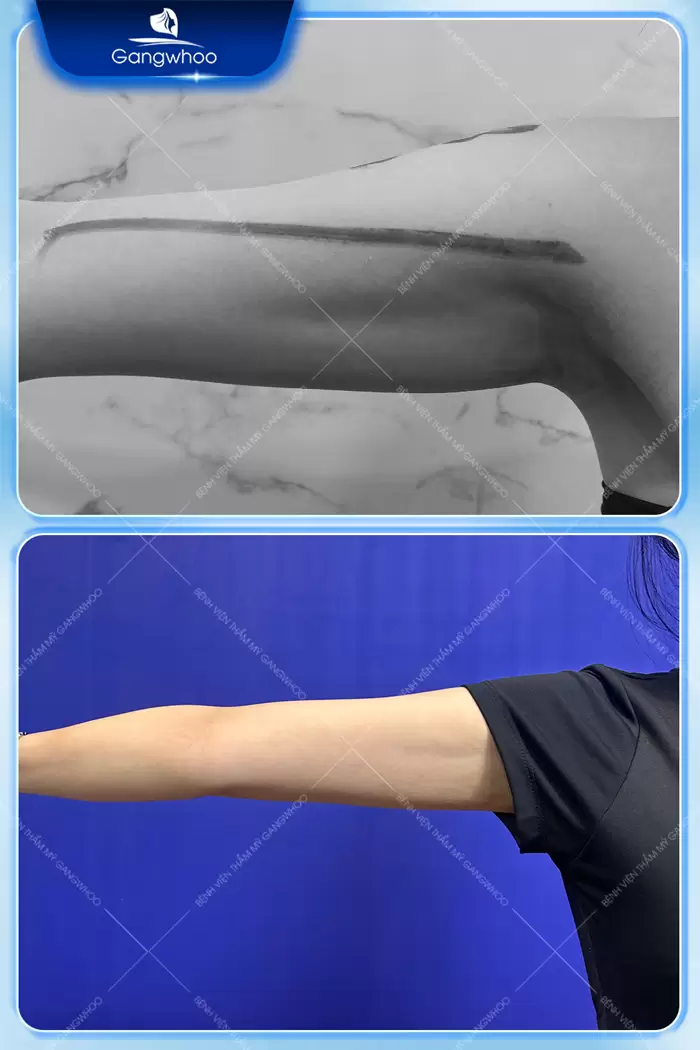 Arm Liposuction – Get Rid Of Chubby Arms