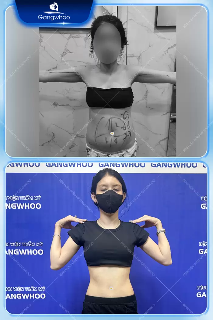 Arm Liposuction – Get Rid Of Chubby Arms