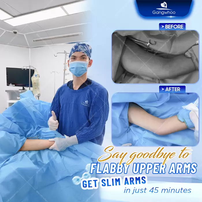 Arm Liposuction – Get Rid Of Chubby Arms
