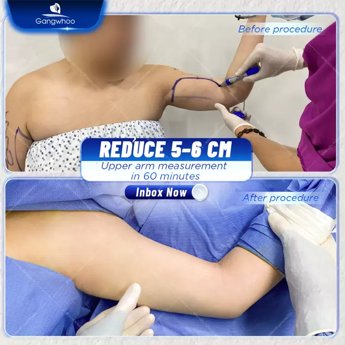 Arm Liposuction – Get Rid Of Chubby Arms