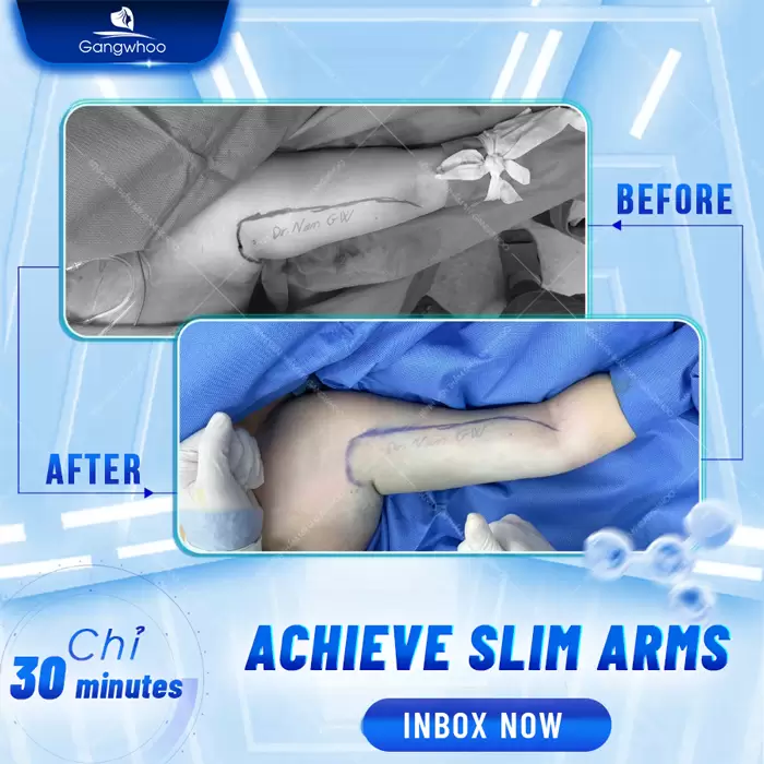 Arm Liposuction – Get Rid Of Chubby Arms