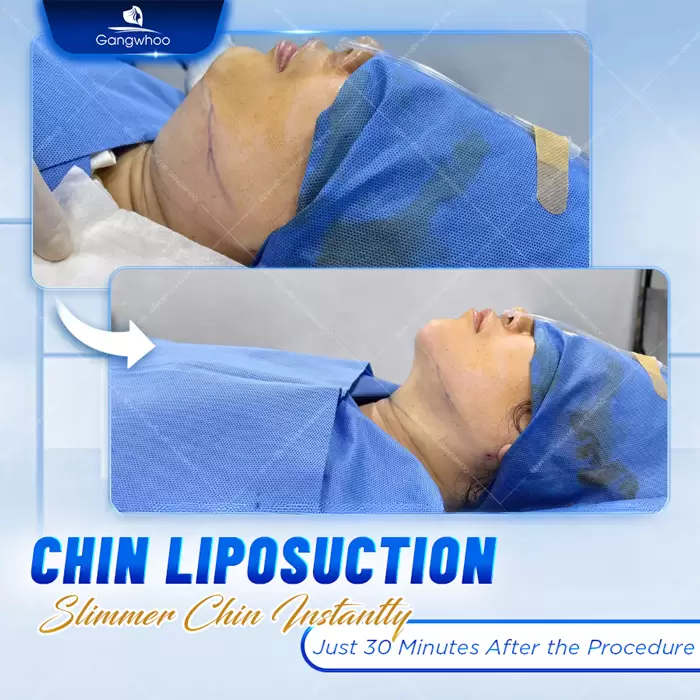 Chin Liposuction – Destroy Chin Fat In A Glance