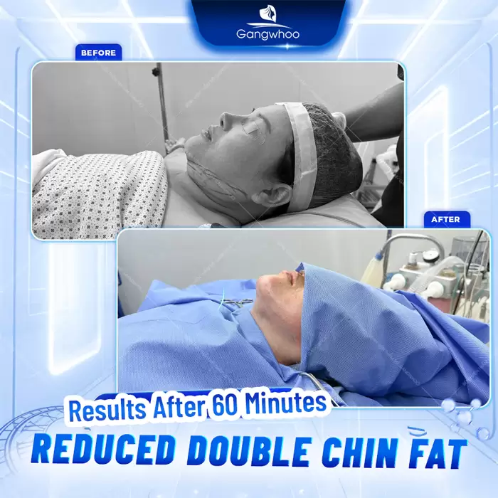 Chin Liposuction – Destroy Chin Fat In A Glance