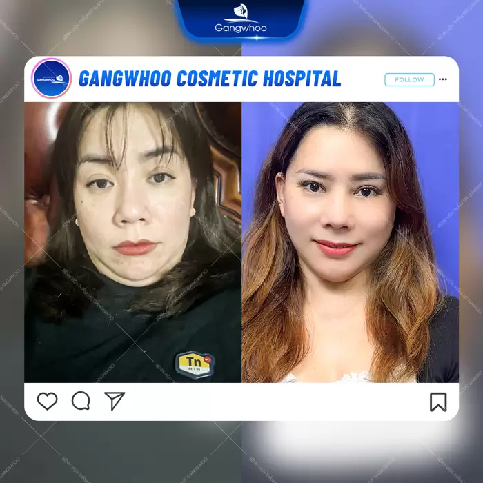 Chin Liposuction – Destroy Chin Fat In A Glance