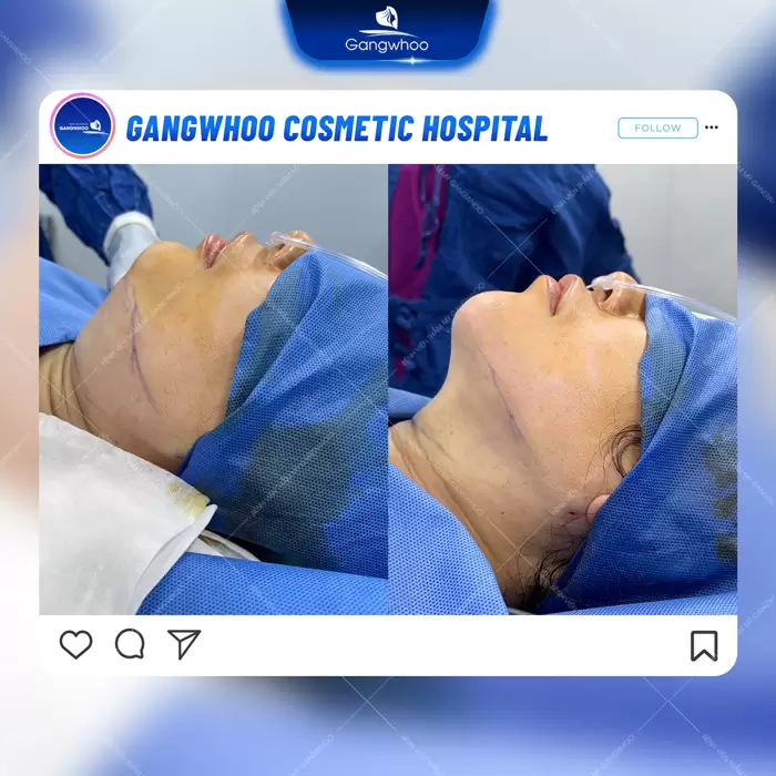 Chin Liposuction – Destroy Chin Fat In A Glance