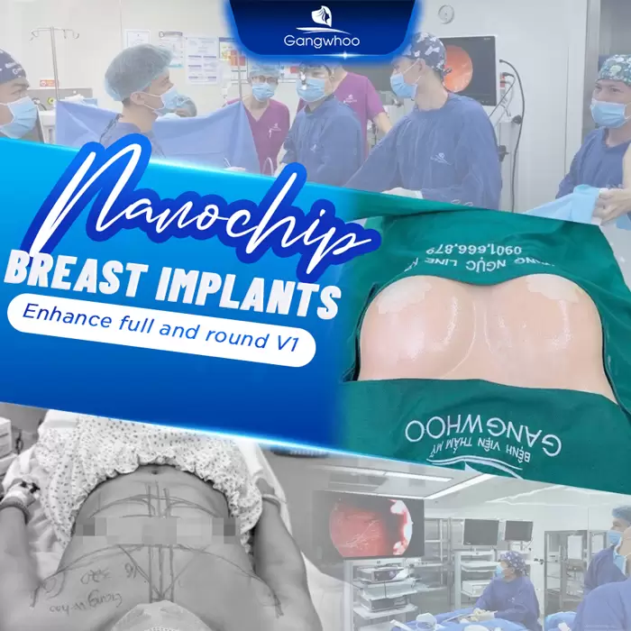 Laparoscopic Breast Augmentation with Nanochip Implant – For A Natural Breast Form