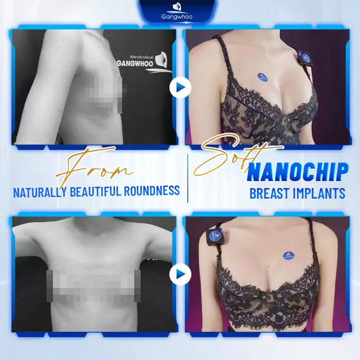 Laparoscopic Breast Augmentation with Nanochip Implant – For A Natural Breast Form