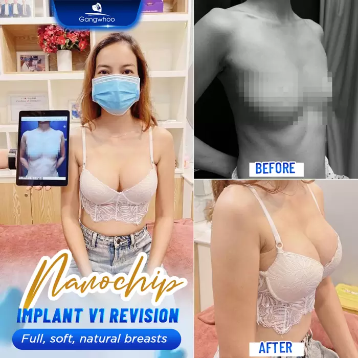 Laparoscopic Breast Augmentation with Nanochip Implant – For A Natural Breast Form
