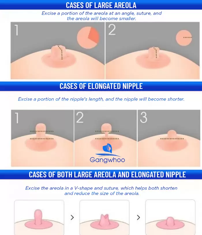 Nipple Reduction – Petite and Pretty