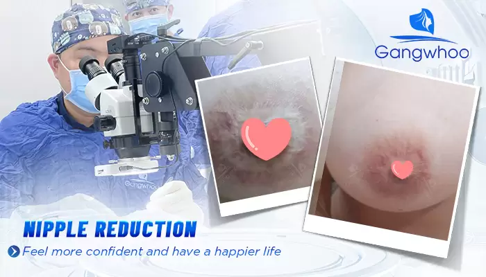 Nipple Reduction – Petite and Pretty