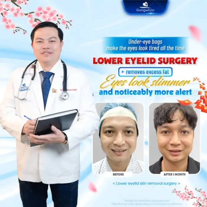 Endoscopic Eyelid Fat Removal – Get Back Your Youth