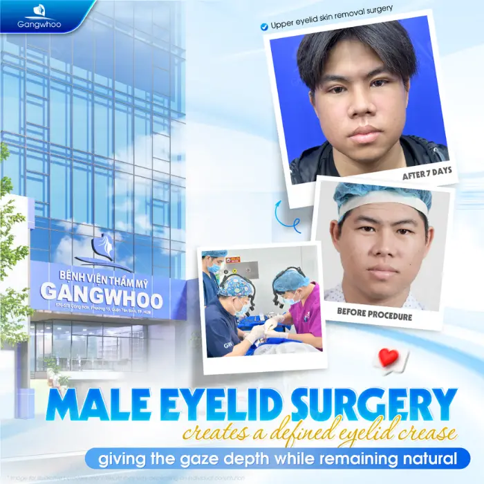 Eyelid Method Blepharoplasty – Bring To You The Most Charming Beauty
