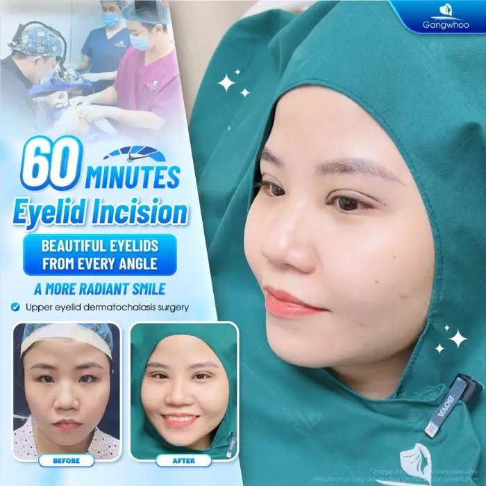 Eyelid Method Blepharoplasty – Bring To You The Most Charming Beauty
