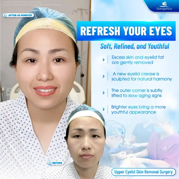 Eyelid Method Blepharoplasty – Bring To You The Most Charming Beauty