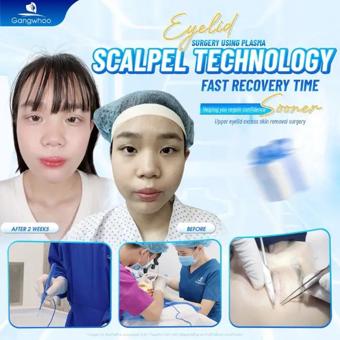 Eyelid Method Blepharoplasty – Bring To You The Most Charming Beauty