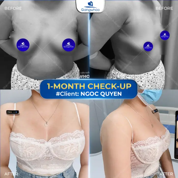 Fat Grafting For Breast Augmentation – Natural Breasts With No Complication
