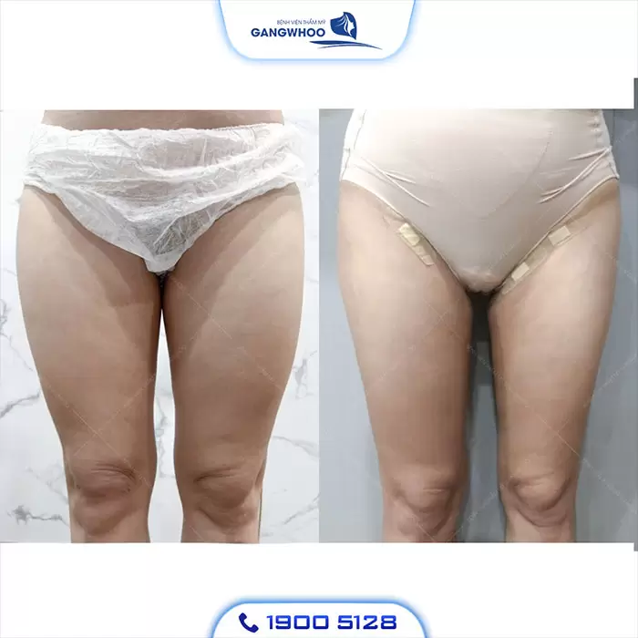 Calf Liposuction – Farewell Your Oversize Legs