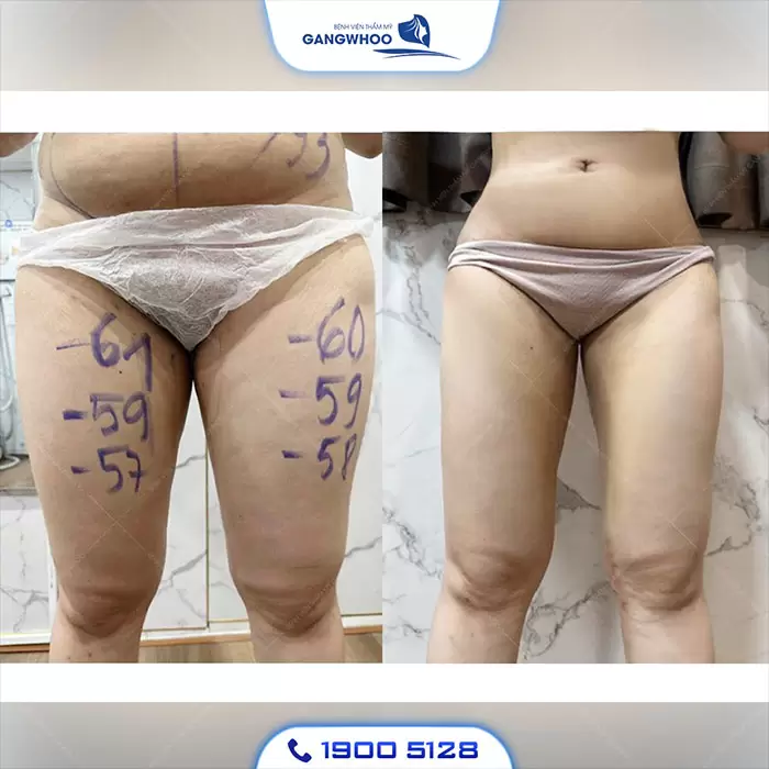 Calf Liposuction – Farewell Your Oversize Legs