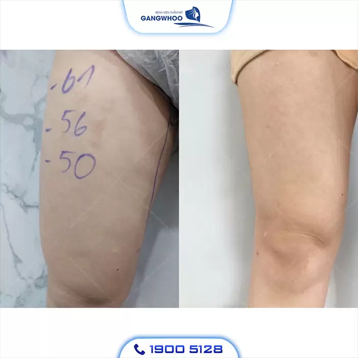Calf Liposuction – Farewell Your Oversize Legs