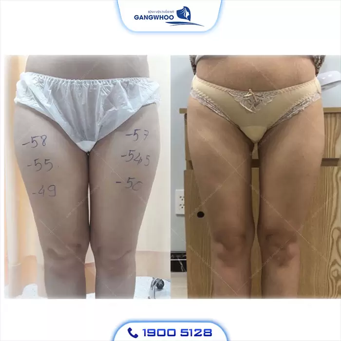 Calf Liposuction – Farewell Your Oversize Legs