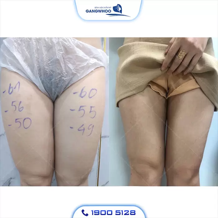 Calf Liposuction – Farewell Your Oversize Legs