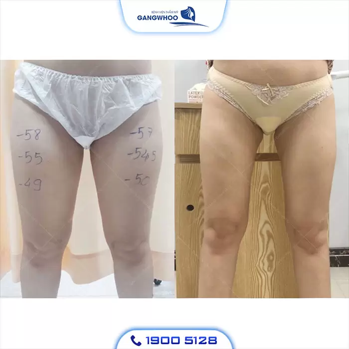 Calf Liposuction – Farewell Your Oversize Legs