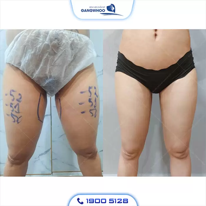 Calf Liposuction – Farewell Your Oversize Legs