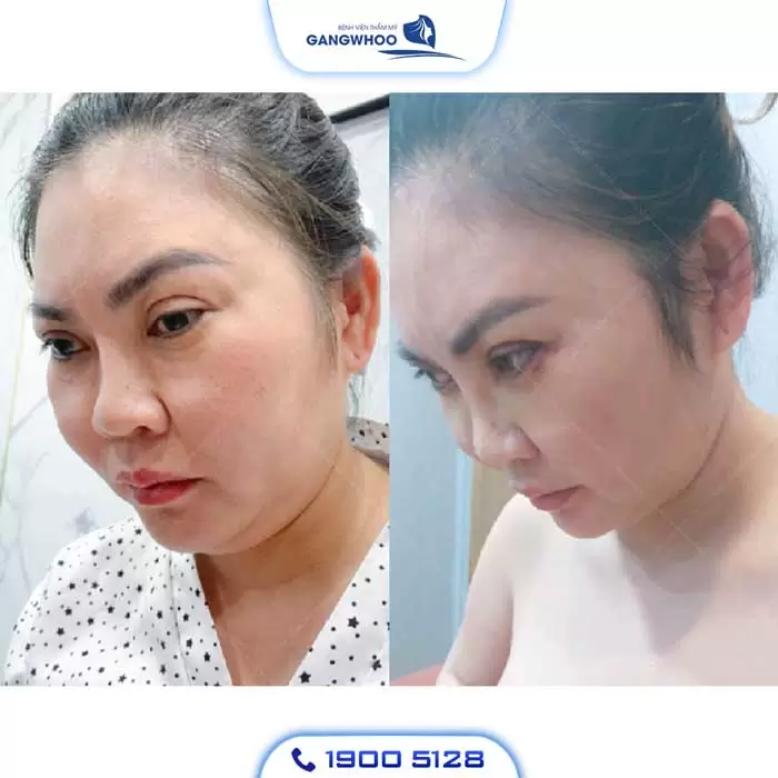 Chin Liposuction – Destroy Chin Fat In A Glance