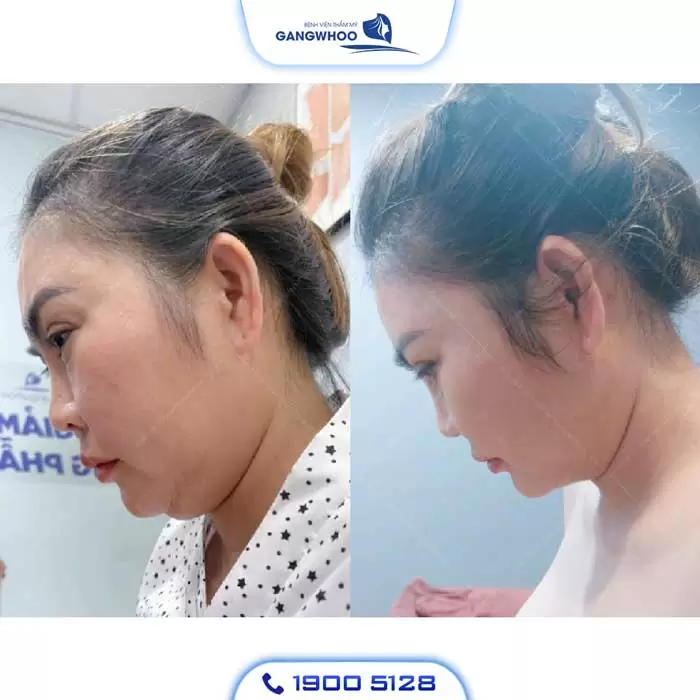 Chin Liposuction – Destroy Chin Fat In A Glance