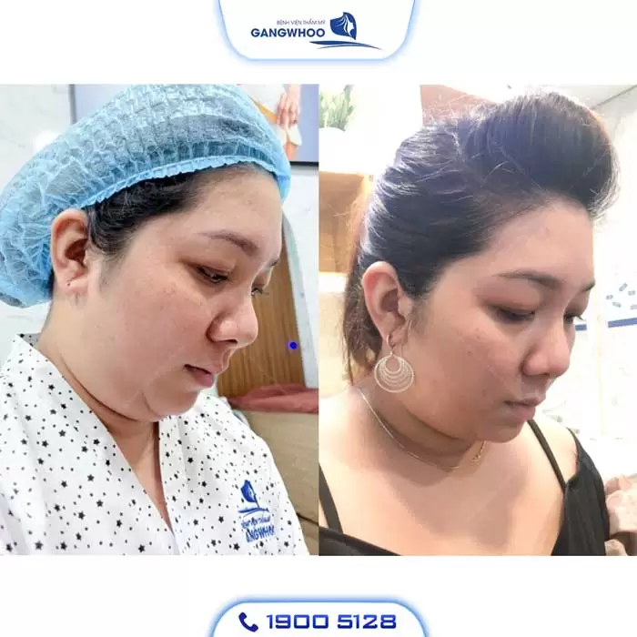 Chin Liposuction – Destroy Chin Fat In A Glance