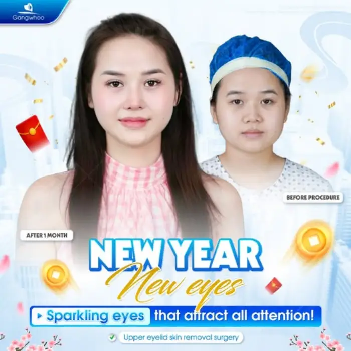 Korean Non-incisional Blepharoplasty – Possess The Beauty Of A Korean Star