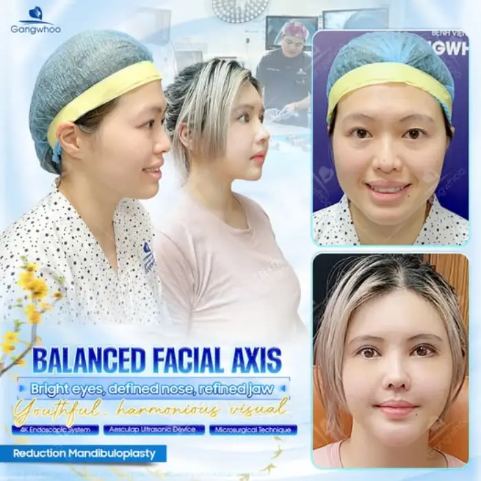 Korean Non-incisional Blepharoplasty – Possess The Beauty Of A Korean Star