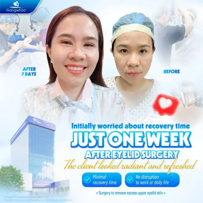 Korean Non-incisional Blepharoplasty – Possess The Beauty Of A Korean Star