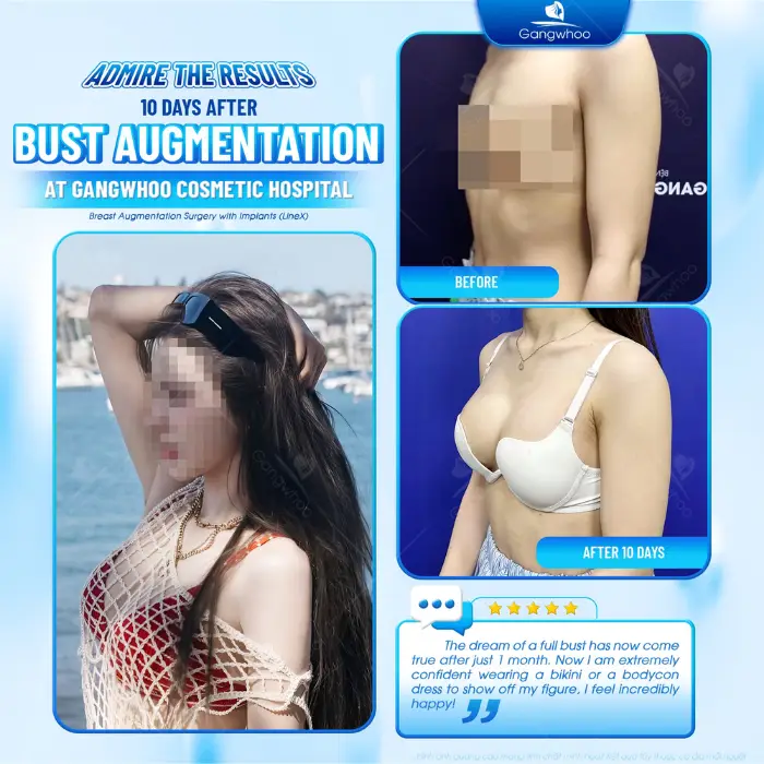 Line X Breast Augmentation – The Perfect Breast Shape