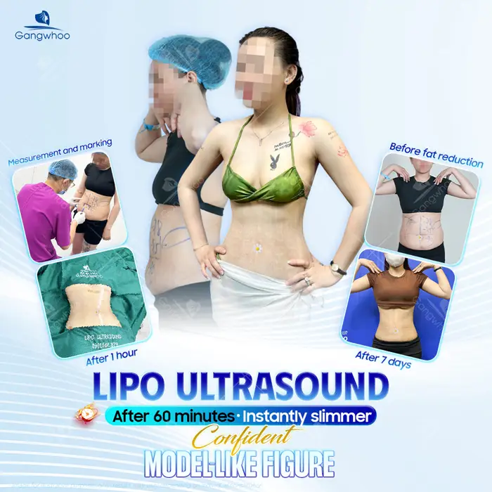 Lipo Ultrasound – A Non-Surgical and Safe Fat Reduction Procedure