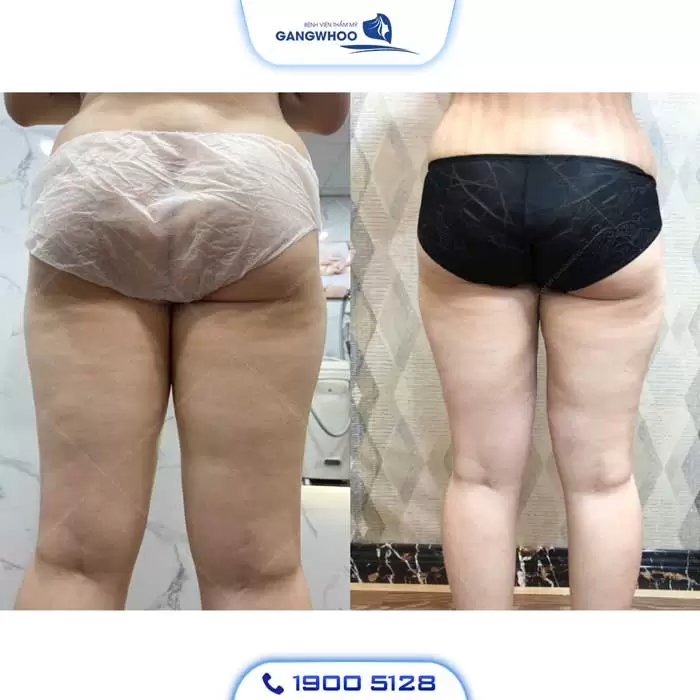 Calf Liposuction – Farewell Your Oversize Legs