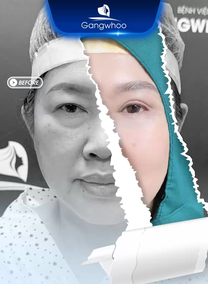 Medial Canthoplasty – For Charming and Flawless Eyes