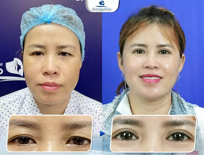 Medial Canthoplasty – For Charming and Flawless Eyes