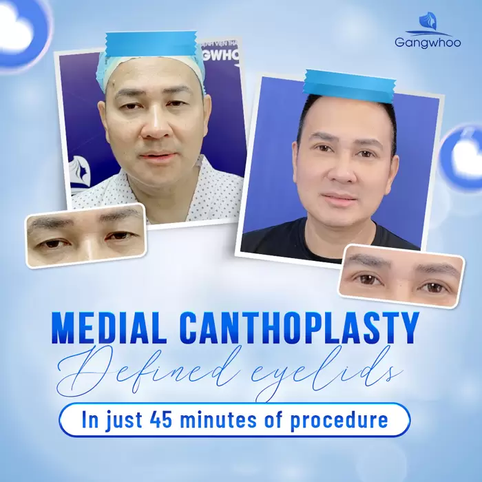 Medial Canthoplasty – For Charming and Flawless Eyes