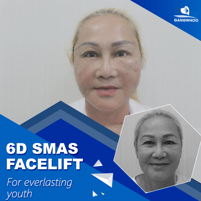 Facelift