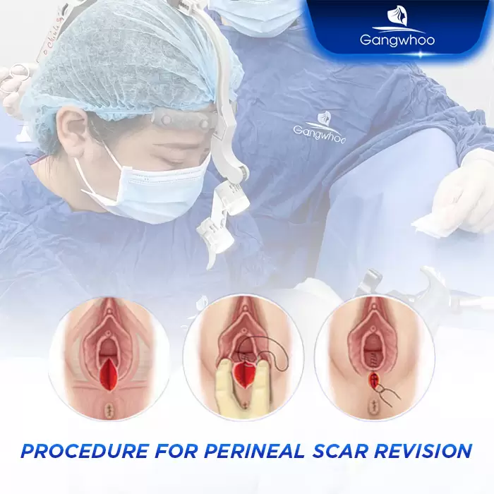 Perineoplasty – Be Sexier, Be More Charming