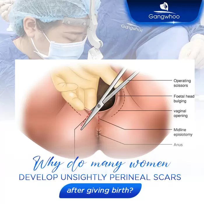 Perineoplasty – Be Sexier, Be More Charming