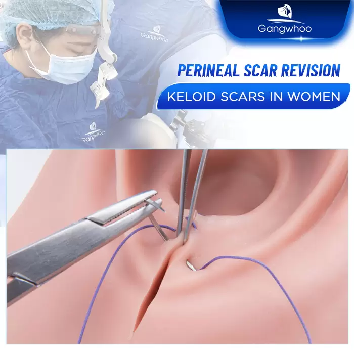 Perineoplasty – Be Sexier, Be More Charming