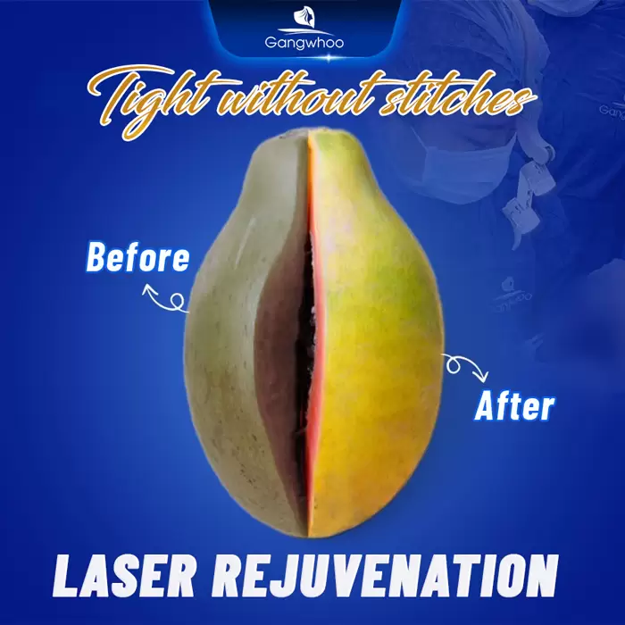 Genital Rejuvenation Using Laser – Make Yourself Younger and Sexier