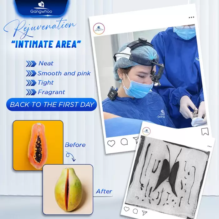 Genital Rejuvenation Using Laser – Make Yourself Younger and Sexier