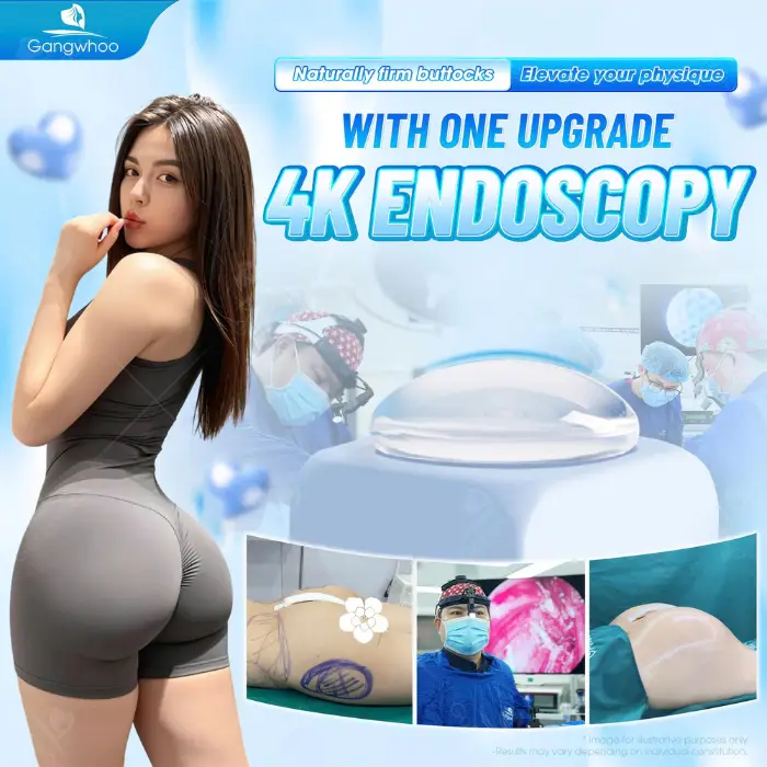 Laparoscopic Buttocks Augmentation – Bigger Butt, Happier Life