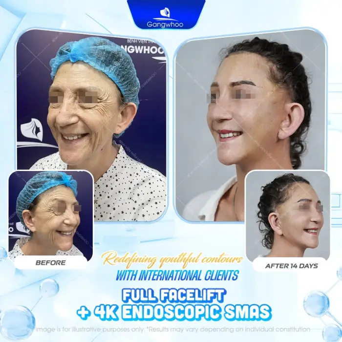 SMAS FACELIFT – LIFE-CHANGING RESULT AFTER ONLY 1 AMAZING PROCEDURE