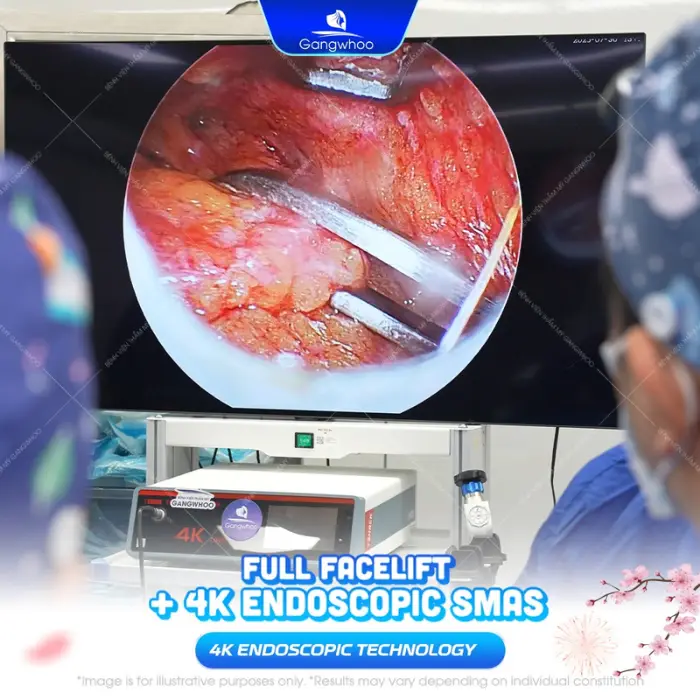 SMAS FACELIFT – LIFE-CHANGING RESULT AFTER ONLY 1 AMAZING PROCEDURE